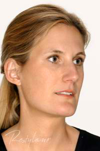 cheek enhancement London